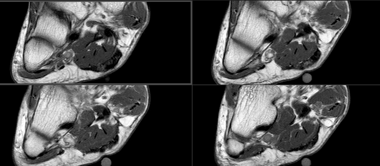 Figure 4 for case Plantar fibromatosis